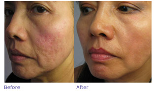 microneedling