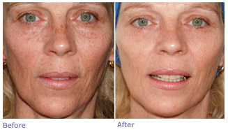Microneedling